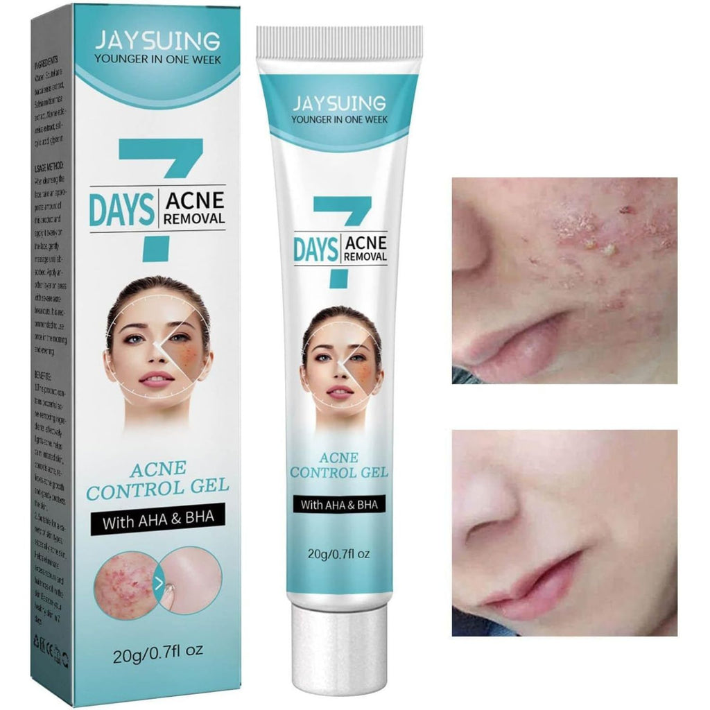 Crema tratamiento acné mascarilla facial