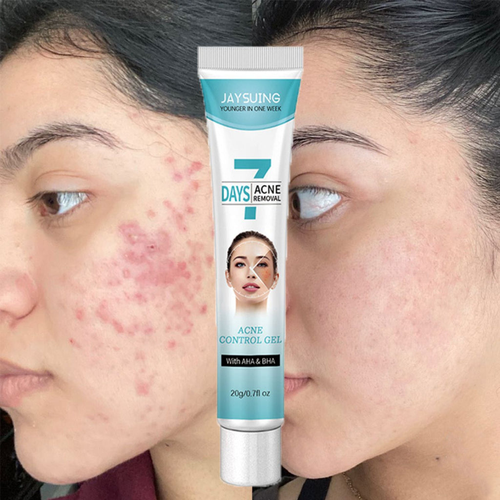 Crema tratamiento acné mascarilla facial