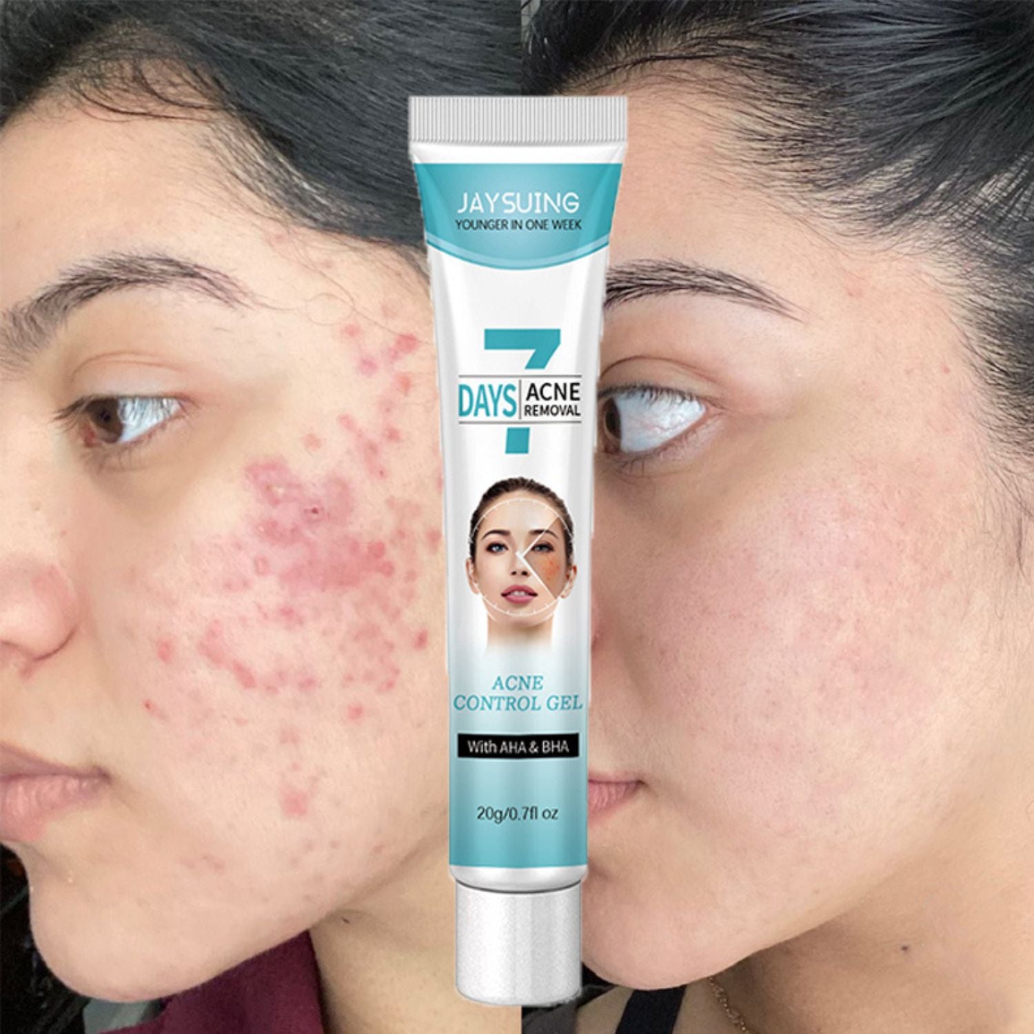 Crema tratamiento acné mascarilla facial